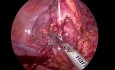 Pontage Oeso-gastrique Laparoscopique avec Interposition Colique pour Sténose Oesophagienne et Gastrique Caustique