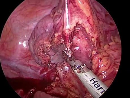 Pontage Oeso-gastrique Laparoscopique avec Interposition Colique pour Sténose Oesophagienne et Gastrique Caustique