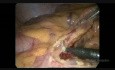 Hémicolectomie gauche par voie coelioscopique pour cancer du côlon provoquant une occlusion intestinale