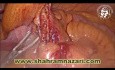 Agrafage de base d'appendicectomie laparoscopique
