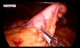 Gastrectomie en manchon avec réparation d'hernie