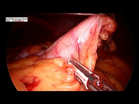 Gastrectomie en manchon avec réparation d'hernie