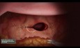 Hystérectomie Laparoscopique - Fermeture du Dôme Vaginal avec Sutures à Micro-Barbes Unidirectionnelles Quill®