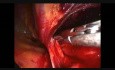 Hernioplastie inguinale par voie laparoscopique avec utilisation d'une prothèse 3D MAX