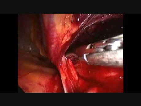 Hernioplastie inguinale par voie laparoscopique avec utilisation d'une prothèse 3D MAX