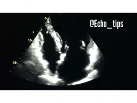 4. Cas d'échocardiographie - Qu'est-ce que vous voyez ?