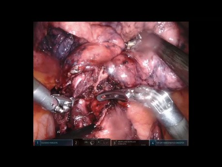 Résection du lobe pulmonaire supérieur gauche assistée par robot