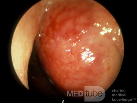 Carcinome du nasopharynx