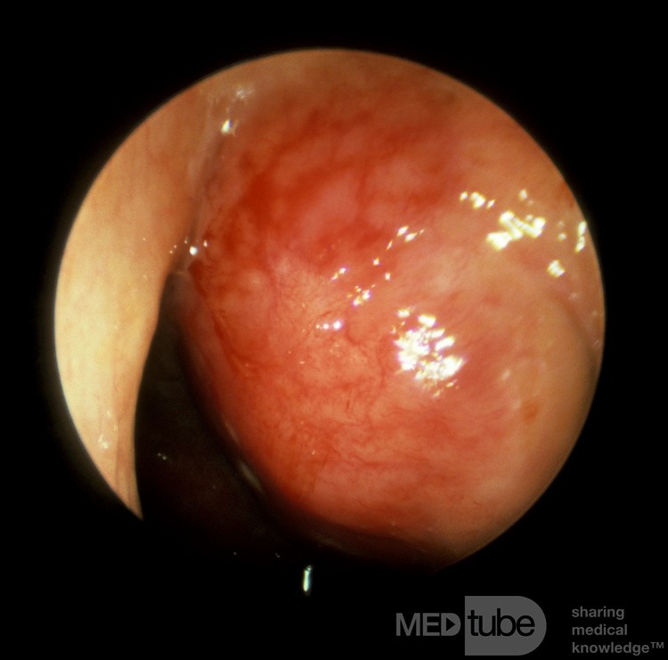 Carcinome du nasopharynx