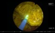 Lithotripsie des calculs vésicaux avec laser Thulium YAG pulsé