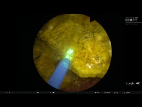 Lithotripsie des calculs vésicaux avec laser Thulium YAG pulsé