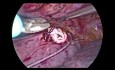 Anastomose Intrathoracique par Agrafage