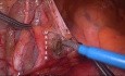 Amputation abdomino-périnéale du rectum  (AAP)