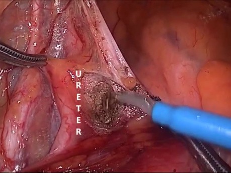 Amputation abdomino-périnéale du rectum  (AAP)