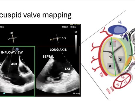 Introduction à l'Echocardiographie 3D, Partie 2 : Évaluation des Valves Mitrale, Tricuspide, Aortique, de la CIA et de l'Oreillette Gauche