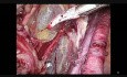 Cancer de l'Endomètre
