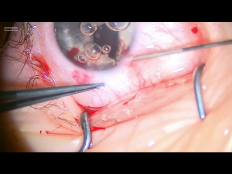Chirurgie plastique du aniridie partielle congénital réalisé chez un patient de 5 ans, avec une bonne acuité visuelle et avec un cristallin préservé.