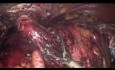 Dégastro-gastrectomie par laparoscopie