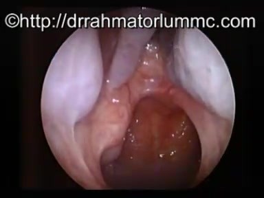 Antrostomie du méat inférieur droit, polypes antraux