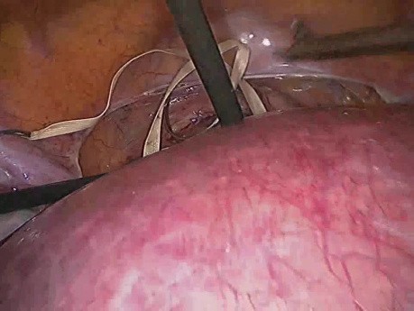 Resserrement du système d'exploitation cervical laparoscopique