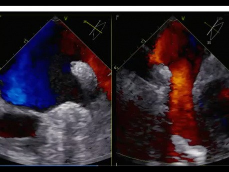 8. Cas d'échocardiographie - Qu'est-ce que vous voyez ?