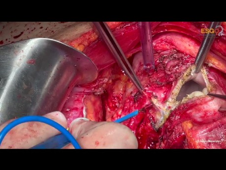 Chirurgie Cytoréductrice du Cancer de l'Ovaire. Version non éditée: Partie III Bassin.