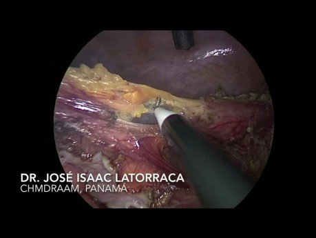 Intervention de Hartmann par voie laparoscopique pour un volvulus du côlon sigmoïde