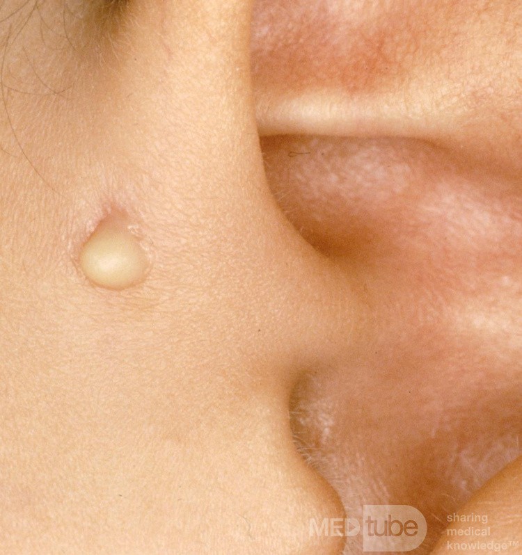 Sinus préauriculaire infecté [gauche]