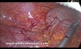Appendicectomie Laparoscopique avec l'utilisation d'Agrafeuse
