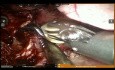 Cancer du poumon après la chimiothérapie néoadjuvante