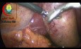 Le point de suture pour la traction de la vésicule biliaire dans les formes aigues