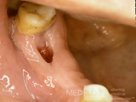 Fistule Oroantrale