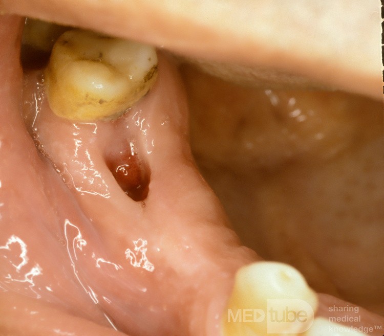 Fistule Oroantrale