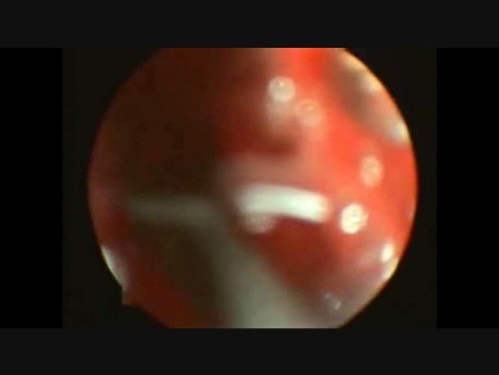 FESS avec sinusite récurrente bilatérale et opacité des sinus CT