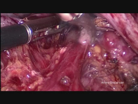 Chirurgie cytoréductive du cancer de l'ovaire. La péritonectomie pelvienne laparoscopique.