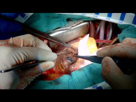 Réparation des défauts septaux ventriculaires après un infarctus du myocarde