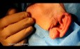Abord Trans-Auriculaire du Condyle Mandibulaire