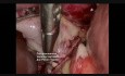 Cholécystectomie laparoscopique - Gangrène et empyème de la vésicule biliaire