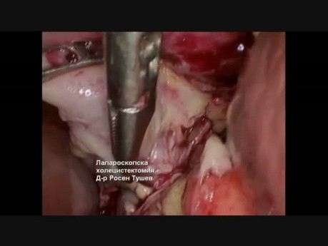 Cholécystectomie laparoscopique - Gangrène et empyème de la vésicule biliaire