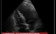 Infarctus ancien de la paroi antérieure du myocarde - dyskinésie de la paroi apicale du ventricule gauche (échocardiographie)