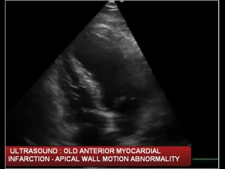 Infarctus ancien de la paroi antérieure du myocarde - dyskinésie de la paroi apicale du ventricule gauche (échocardiographie)