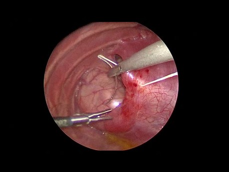 Hernie diaphragmatique congénitale