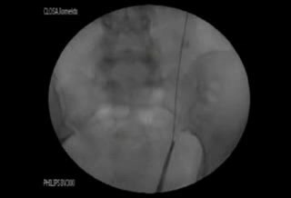 Calcul urinaire - lithotripsie au LASER en urétéroscopie.