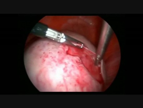 Résection d'un grand kyste dermoïde par voie laparoscopique