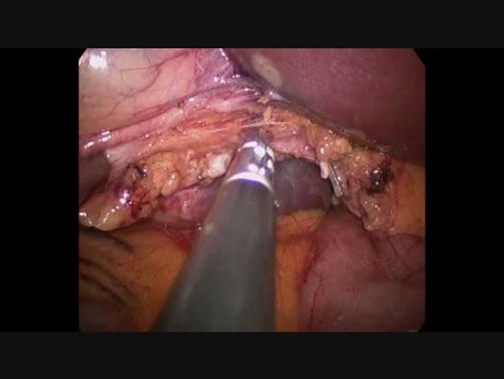 Cholécystectomie SILS avec Gelpoint et crochet articulé