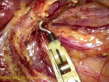 Résection antérieure du cancer du côlon sigmoïde par voie laparoscopique