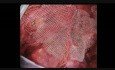 Traitement de la hernie inguinale par coelioscopie. Étape 9: fixation du filet 