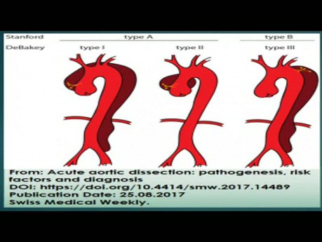 Dissection aortique: échocardiographie transoesophagienne (ETO), angiographie thoracique et traitement