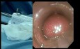 Système StomaphyX dans la chirurgie bariatrique