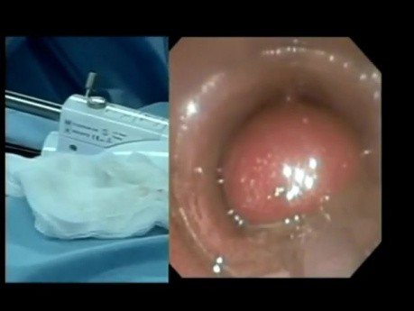 Système StomaphyX dans la chirurgie bariatrique
